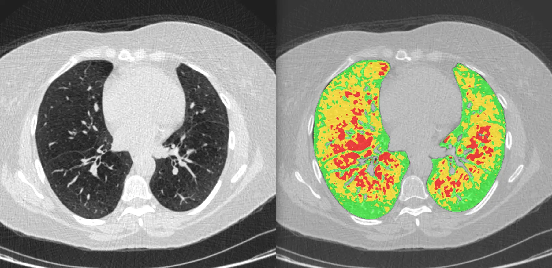 LDA-Functional_Osirix-screenshot-COPD-subject